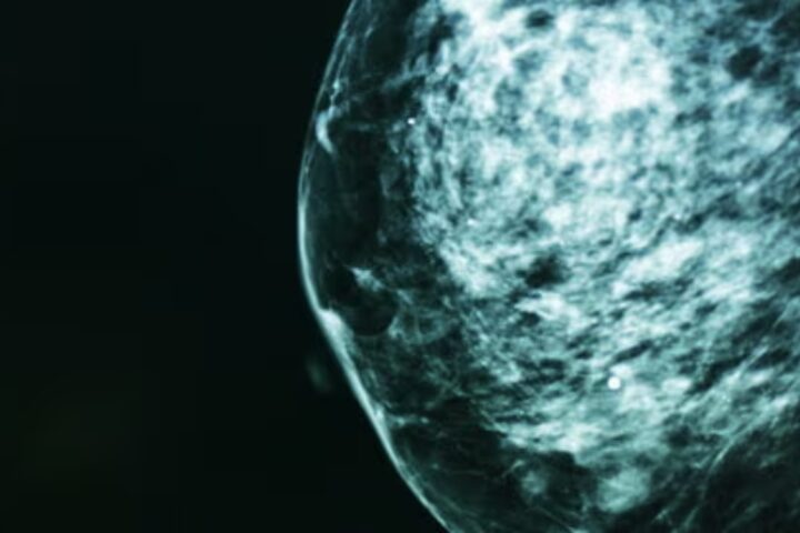 More seasoned ladies’ bosom disease is frequently overdiagnosed, concentrate on finds, raising gamble of superfluous treatment