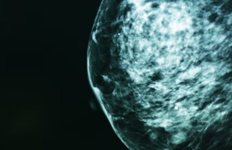 More seasoned ladies’ bosom disease is frequently overdiagnosed, concentrate on finds, raising gamble of superfluous treatment