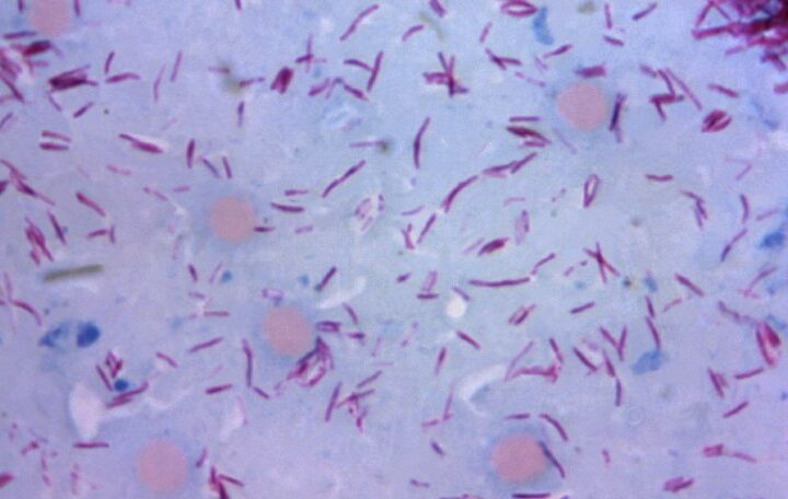 According to the report, Central Florida is a hotbed of leprosy