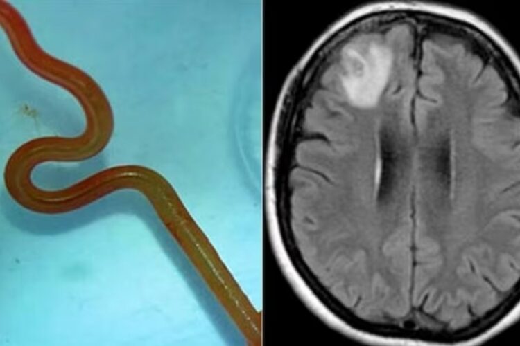 In a world first, a live parasitic worm was discovered in the brain of an Australian woman.